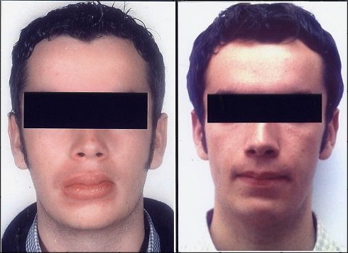 OFG before and after
